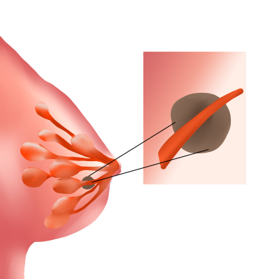 千库网_乳腺恶性肿瘤_元素编号13044687.png