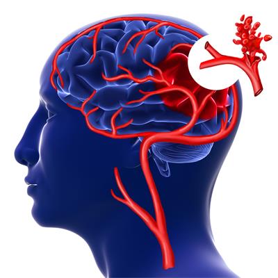 千库网_脑出血3d渲染_摄影图编号764884.jpg