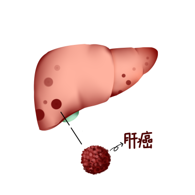 1766456013407369.png 千库网_人体内脏肝癌肝脏医疗疾病_元素编号13366385.png